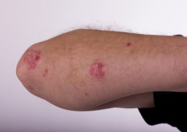 dermatite-atopica